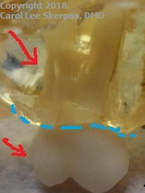 Image of upper WHOLE-TOOTH in a clear model, with bone-level, ROOTs & anatomical 