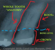 X-Ray of upper tooth with WHOLE-TOOTH 