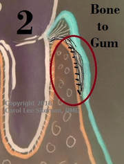Drawn image with the attached gum encircled--i.e., BONE-to-GUM area of attachment