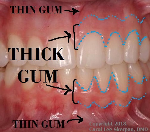 Picture of front teeth with THIN GUM (