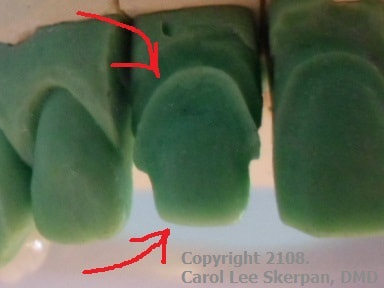 Image of front tooth on lab-model shaped to make ROOM for the 