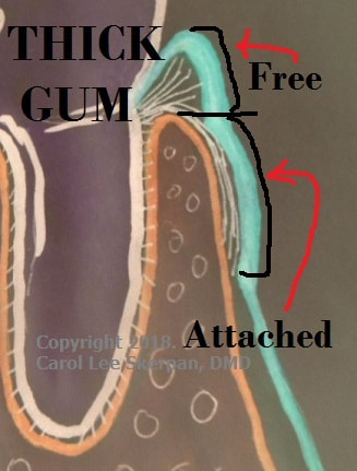 Drawn image shows THICK GUM (free & attached) surrounding the crown-of-the-tooth.....